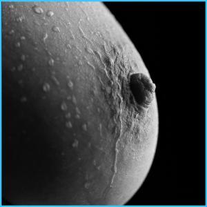 Chirurgie des seins