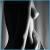 Liposuccion Liposculture 