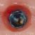 les implants dentaires